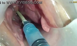 Semen inyectado en el útero de la esposa de otro